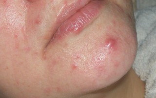 Ayurveda Treatment For Neurodermatitis