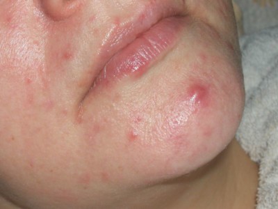 Ayurveda Treatment For Neurodermatitis