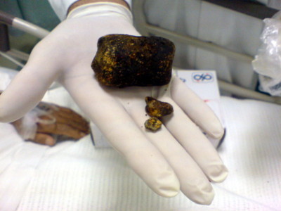 Ayurveda Treatment For Gallstones