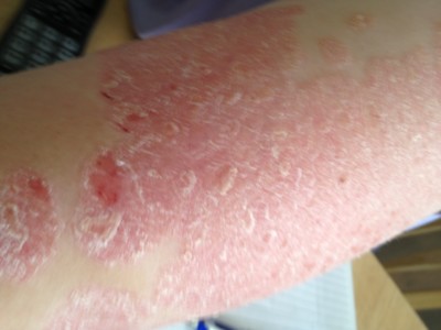 Ayurveda Treatments For Psoriasis