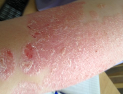 Behandlungen für Psoriasis