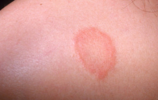 Ayurveda Treatment For Eczema
