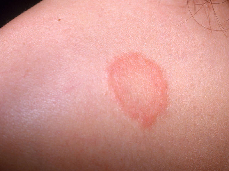 Ayurveda Treatment For Eczema